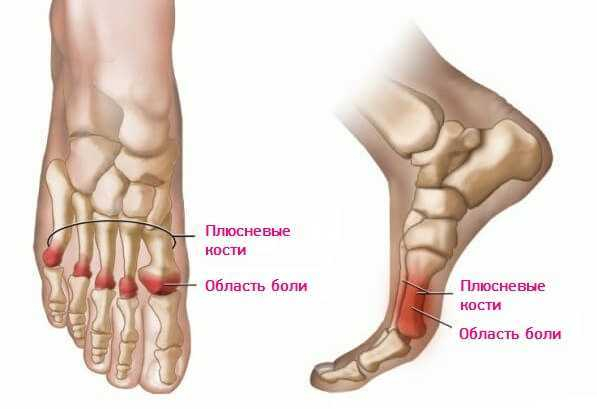 Пятая плюсневая кость стопы. Болит сустав плюсневой кости стопы. Артрит плюсневой кости стопы. Артрит плюсневых костей стопы.